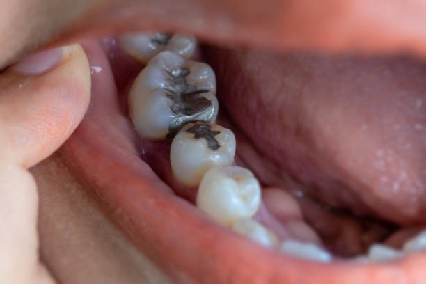 Dental-caries-is holes-in-the-teeth
