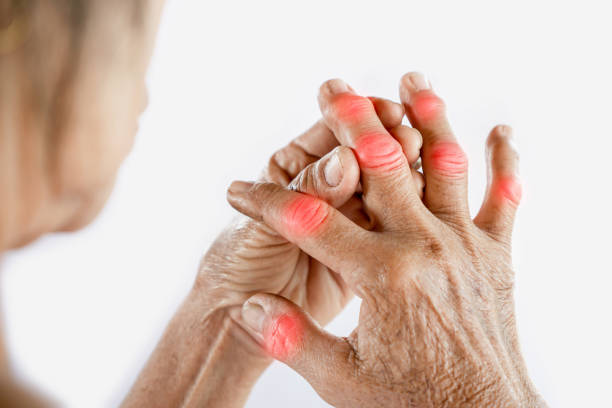 Seronegative arthritis