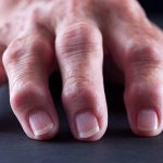 swollen fingers from Seronegative arthritis
