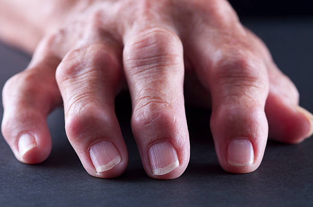 swollen fingers from Seronegative arthritis