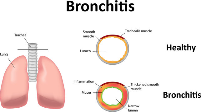 bronchitis illustration