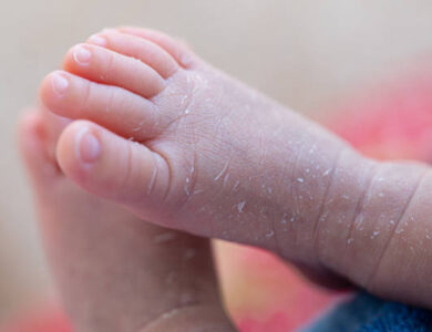 newborn skin peeling